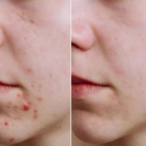 Glowskin Pro® - Máscara LED Antiedad